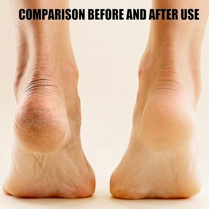 Electric Foot Callus Remover